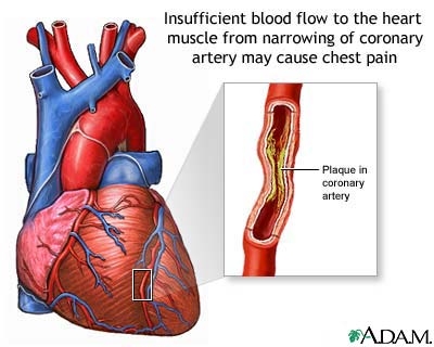 Angina pectoris